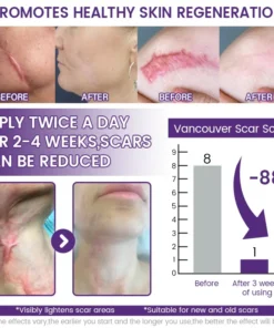Neyeros® ReGenScar Stem Cell Scar Gel